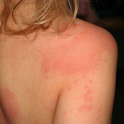 Аллергические высыпания на коже у детей.